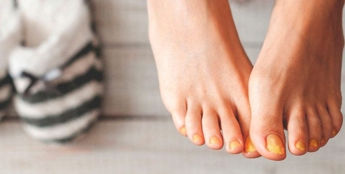 Factores de contagio de onicomicosis