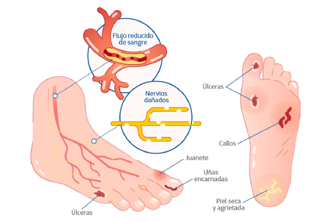 Paciente con diabetes controlando su glucosa