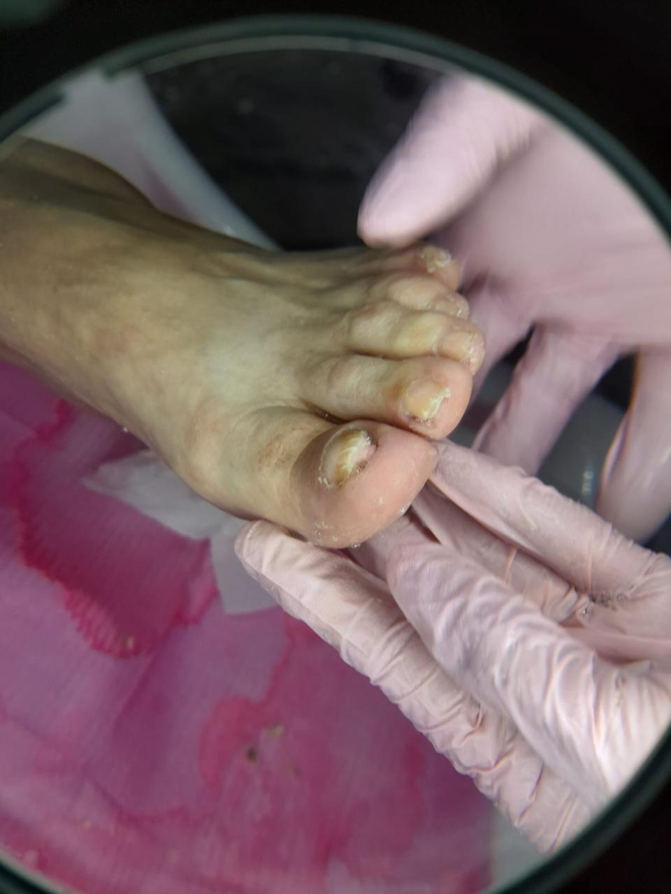 Onicomicosis: Guía completa sobre infección fúngica en uñas