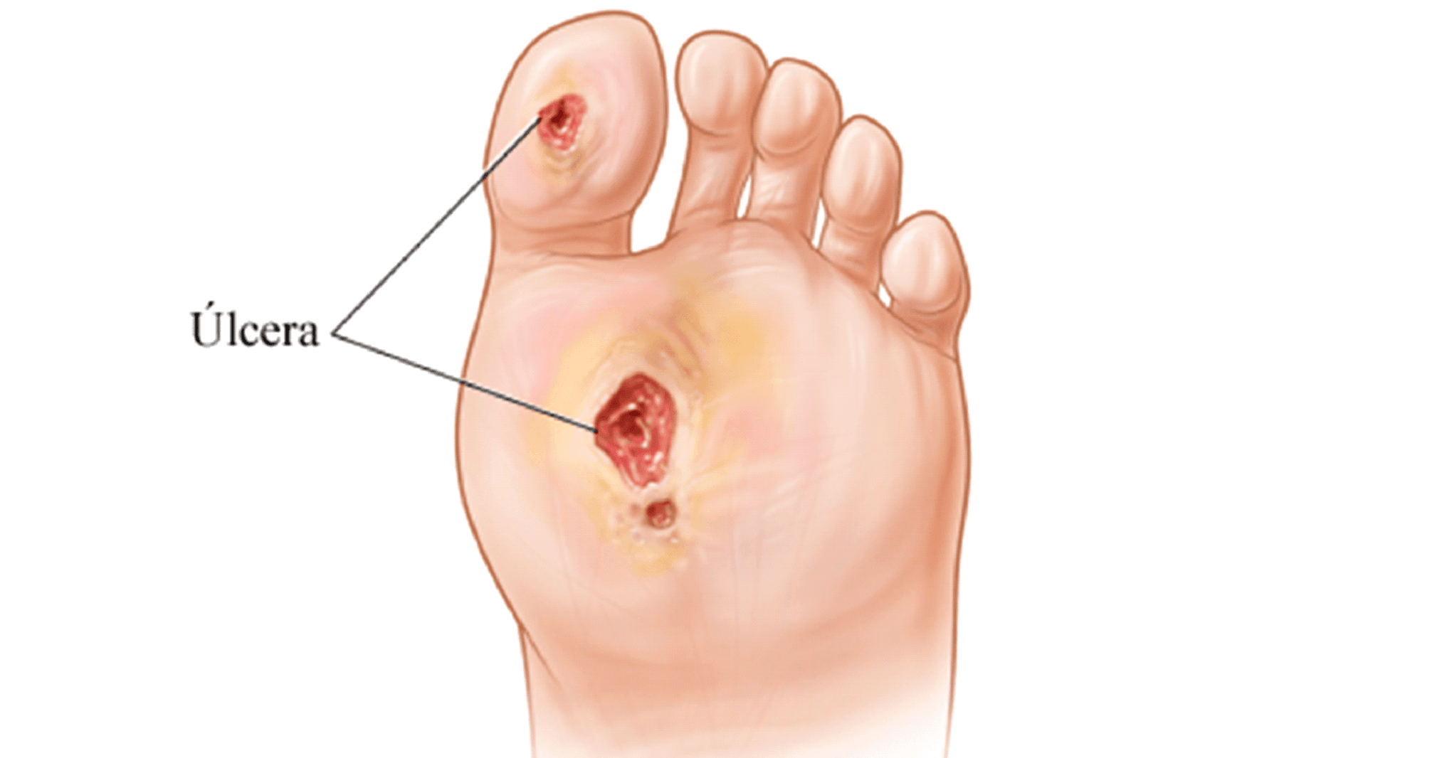 Pie Diabético y Paciente con Diabetes