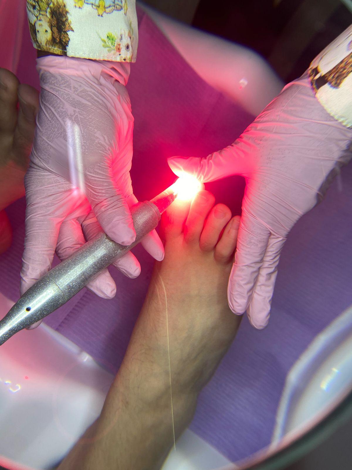 Tratamiento láser para onicomicosis