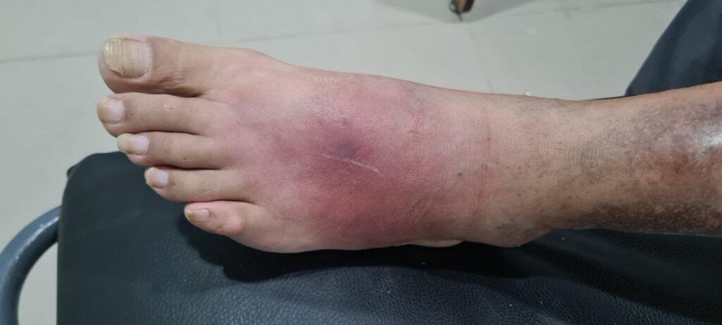 Pie Diabético - Podología La Plata